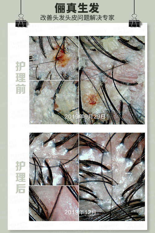 脂溢性皮炎