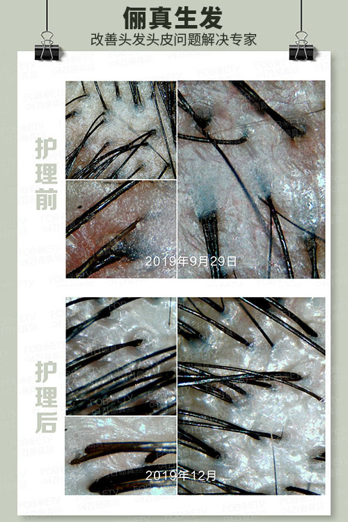頭油、頭癢
