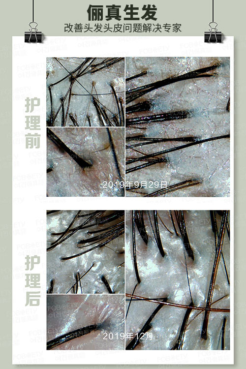 脂溢性皮炎