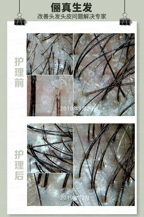 頭油、頭癢
